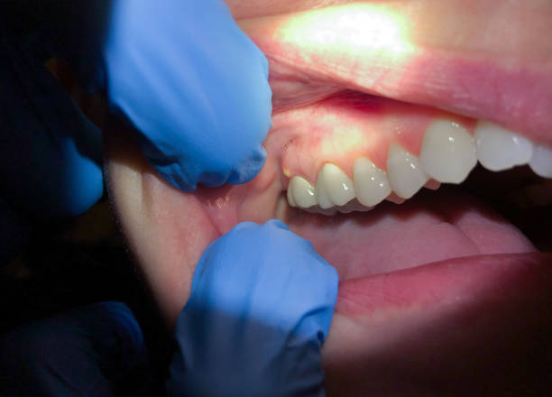 Best Emergency Dentist for Knocked-Out Tooth in University Place, WA